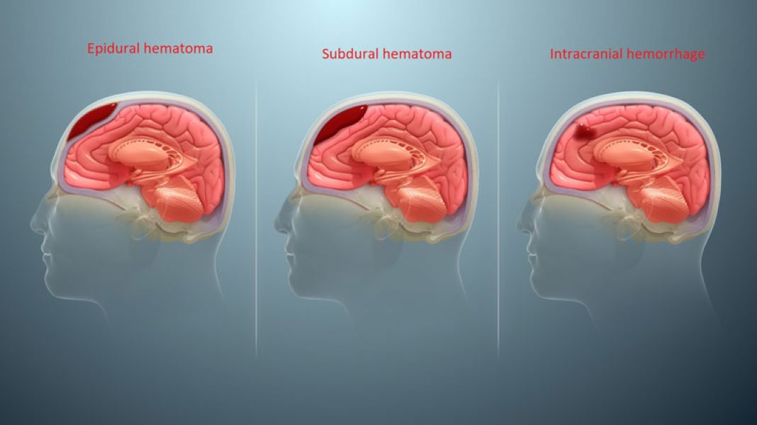 Tụ máu não nguy hiểm dựa theo vị trí tụ máu