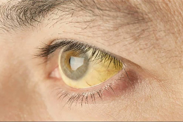 Hiện tượng mắt vàng là gì?