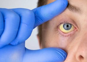 Mắt vàng có phải bệnh gan? Những dấu hiệu đặc biệt cần chú ý sức khỏe